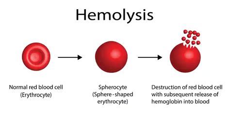Dangerously Low Hemoglobin Levels Low Hemoglobin Page 4 Of 6 Anti