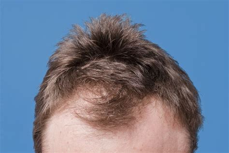 How To Cope With Hair Loss Male A Comprehensive Guide Favorite Men