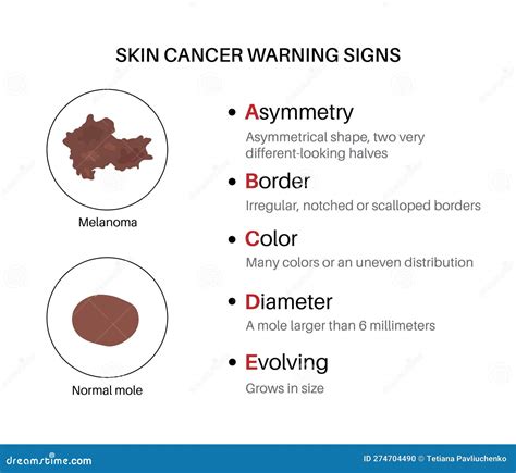 Melanoma Warning Signs Stock Illustration Illustration Of Tissue