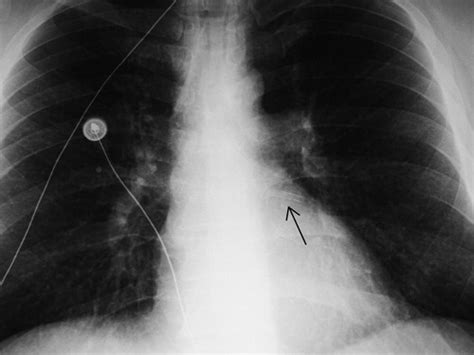 Medical Devices Of The Chest Radiographics