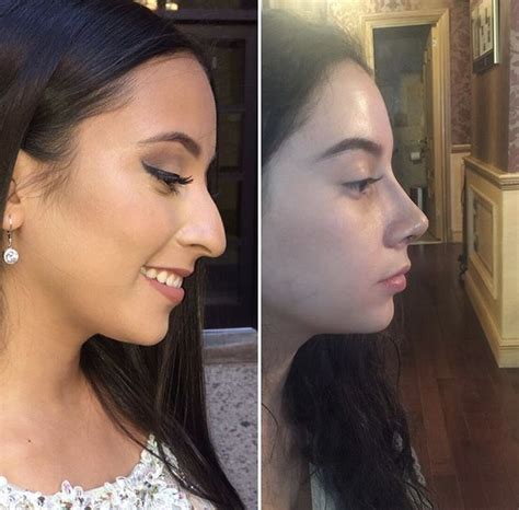 Pin By Katherine Estevez On Rhinoplasty Rhinoplasty Nose Jobs