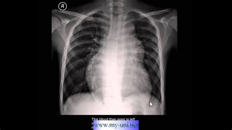 Chest X Ray Pulmonary Arterial Hypertension Youtube