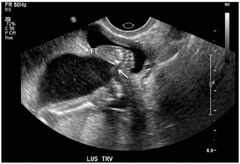 Sonographic Assessment Of Uterine Dehiscence During Pregnancy In Women