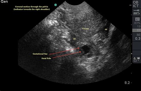 Ruptured Ectopic Pregnancy Ultrasound