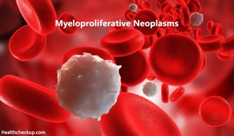 myeloproliferative neoplasms mpns symptoms treatment survival rate