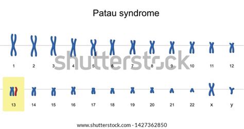 Patau Syndrome Karyotype Autosomal Abnormalities Trisomy Stock Vector Royalty Free 1427362850