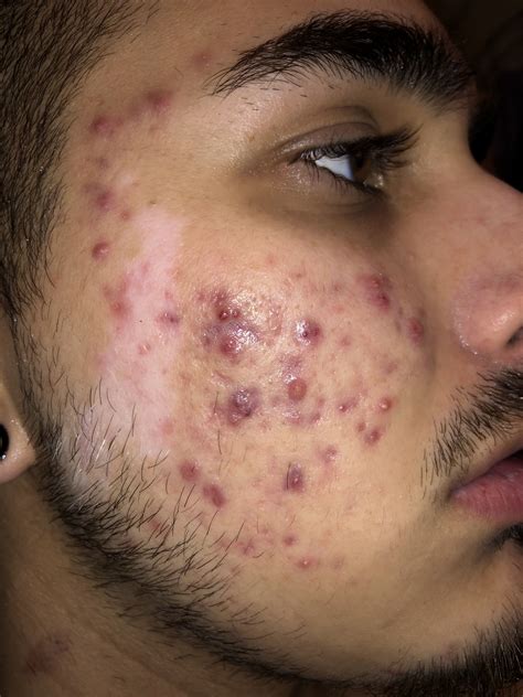 Need Help With My Acne General Acne Discussion Forum