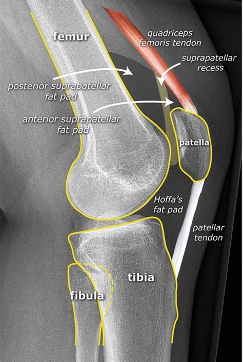 Perfect Lateral Knee X Rays And How To Correct Rotation Ask The Rad Tech