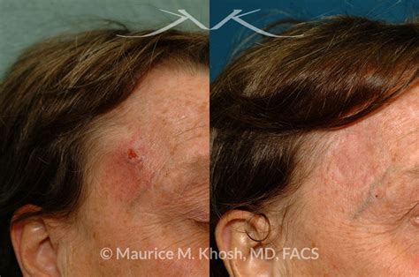 New York Facial Plastic Surgery Moh S Reconstruction Of Forehead And