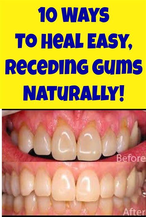 10 Ways To Heal Easy Receding Gums Naturally Receding Gums Gum