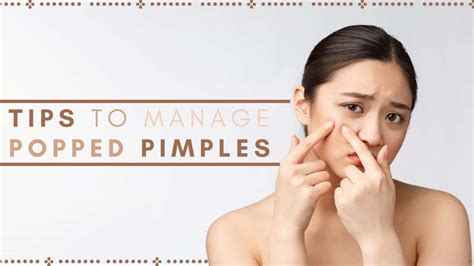 Five Tips To Manage A Popped Pimple Boldsky Com