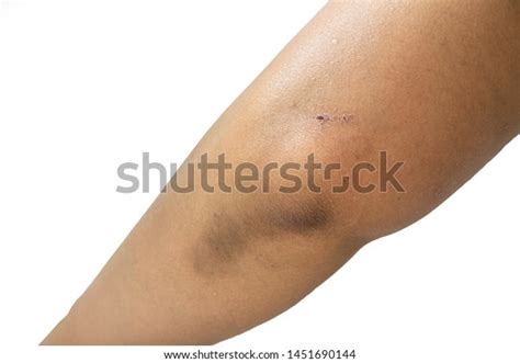 59 Elbow Callus Images Stock Photos And Vectors Shutterstock