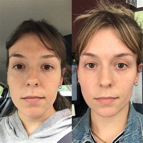 Banda ~3 Months Progress Fading Freckles And Sun Spots Routine In Comments Rskincareaddiction