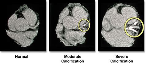Calcium Score Heart Scan What You Need To Know