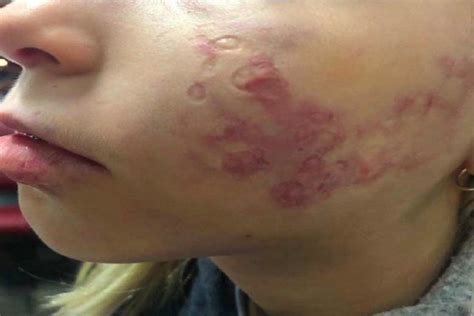 Doctor Scarred Girls Face During Laser Treatment To Remove Birthmark Suit