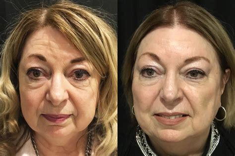 Facelift Threading Before And After