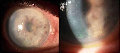 Painless Bilateral Bullous Keratopathy Contact Lens And Anterior Eye