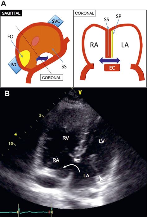 Imaging Of Atrial Septal Defects Echocardiography And Ct Correlation