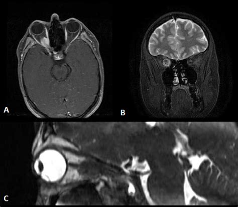 3t Mri A Axial T1 Weighted Sequence Showing A Hyperintense Mass With