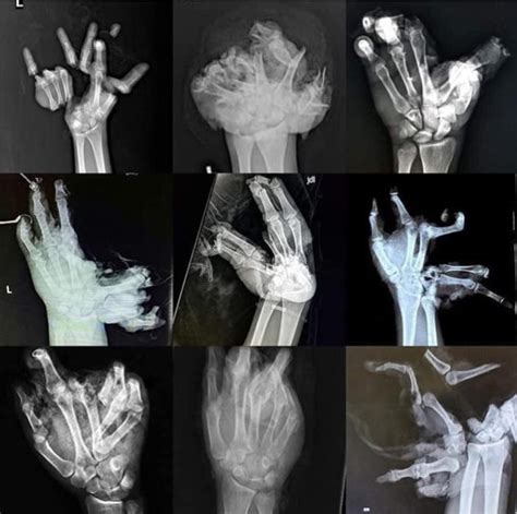 X Rays Of Hands After Firework Accidents 9gag