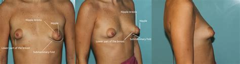 Xxx Puffy And Malformed Tits Lovely Areolas Plastic Surgery
