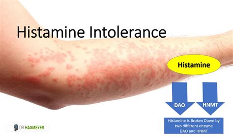 Finding The Cause Of Your Histamine Intolerance Or Mcas Dr Hagmeyer