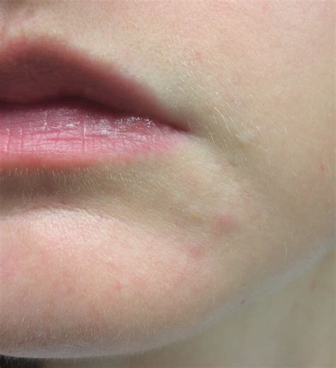 Perioral Dermatitis Rosacea Allergy Pic Rosacea And Facial Redness