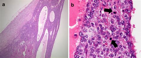 Rapidly Growing Juvenile Granulosa Cell Tumor Of The Ovary Arising In