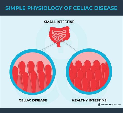Celiac Disease 101 Symptoms Causes And Treatment