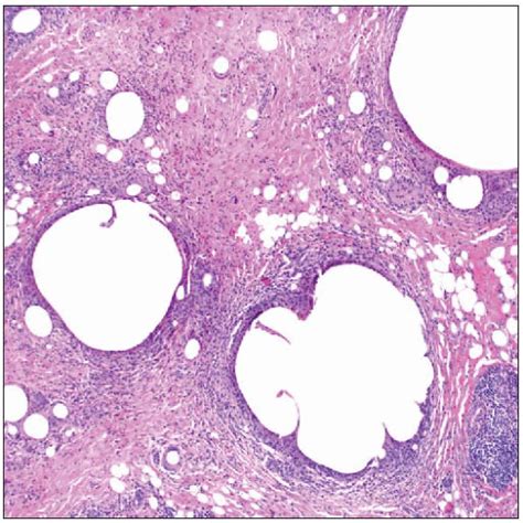 Implant Pathology Basicmedical Key