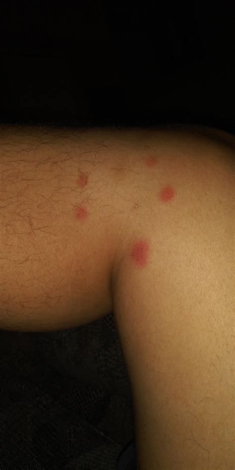 Are These Bedbug Bites Ive Been Having Multiple Bites Mainly On My
