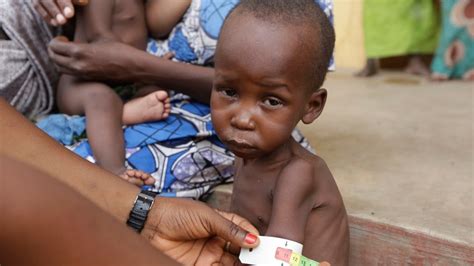 Organizações Angolanas Alertam Que Estado De Desnutrição De Crianças Pode Ser Pior Do Relatado