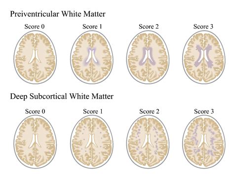 Pathogeneses And Imaging Features Of Cerebral White Matter Lesions Of