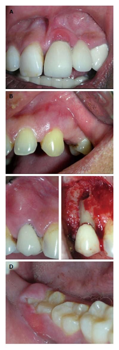 Gingival Enlargements Differential Diagnosis And Review Of Literature