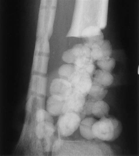 Antibiotic Beads Radiograph Of The Distal Tibia And Fibula Shows