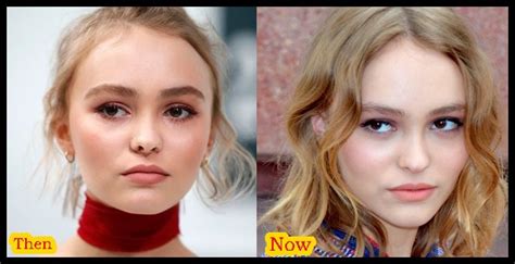 Lily Rose Depp Plastic Surgery Before And After Photos