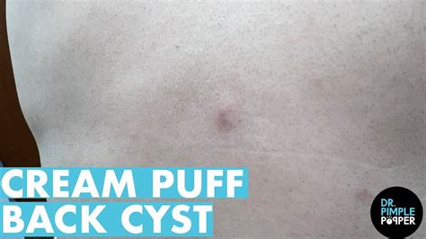 Dr Lee Opens Up Back Cyst Dr Pimple Popper Youtube