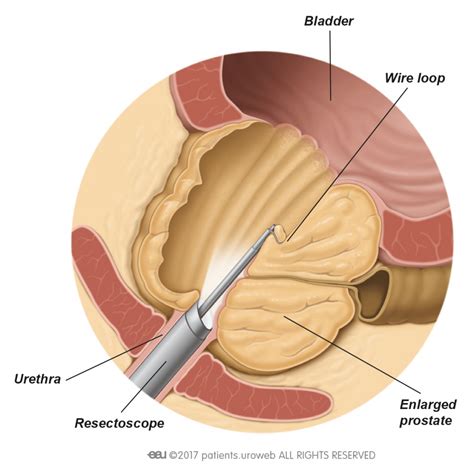 Transurethral Resection Of The Prostate Turp Patient Information
