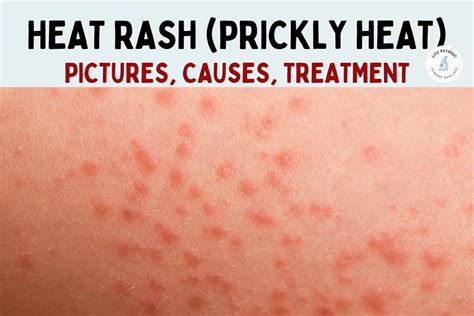 Heat Rash Pictures Symptoms Causes Types And Treatment
