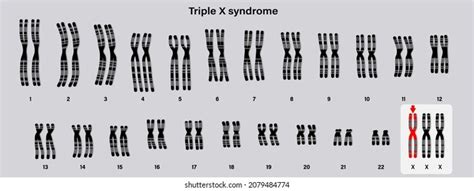 Vektor Stok Human Karyotype Triple X Syndrome Female Tanpa Royalti