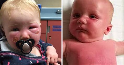 A person who experiences a mild allergic reaction to a sunscreen should remove the. Mom warns others after infant has serious allergic reaction to commonly used sunscreen