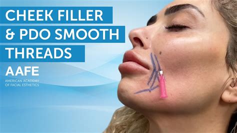 Cheek Filler And Pdo Smooth Threads Aafe Youtube