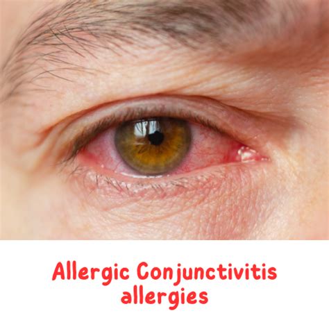 What Is Allergic Conjunctivitis Board Certified Eye Doctors