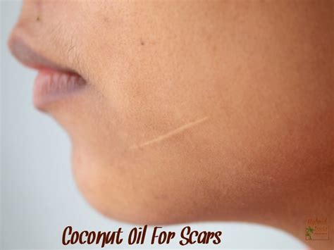 How To Prevent Scarring With Coconut Oil Hybrid Rasta Mama