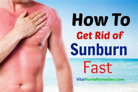 How To Get Rid Of Sunburn Vital Home Remedies Get Rid Of Sunburn