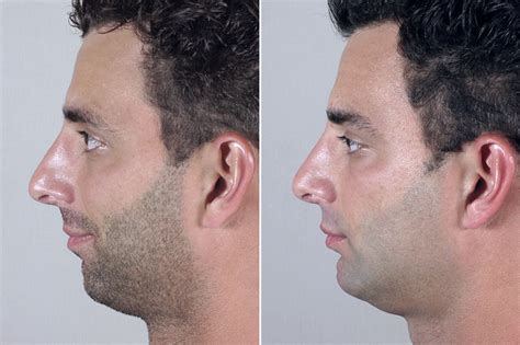 Chin Augmentation For Men New Jersey Parker Center For Plastic Surgery