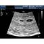 4 Weeks Pregnant Ultrasound Pictures And Description  IYTmedcom