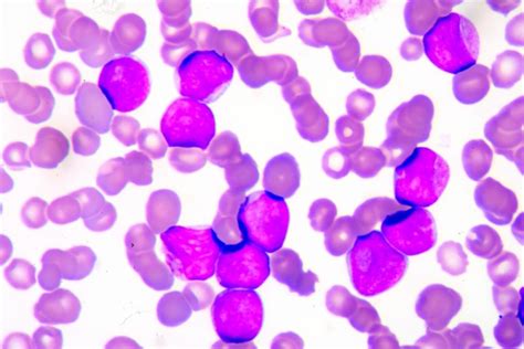 Tibsovo Approved For Acute Myeloid Leukemia