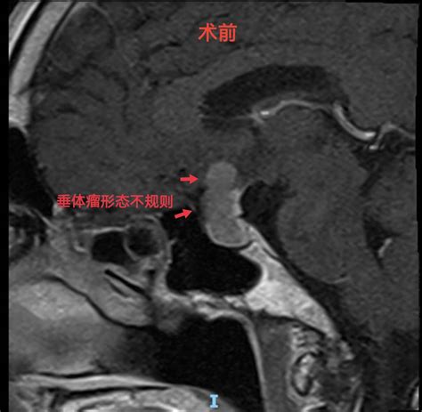 神经内镜经鼻蝶垂体瘤切除术 脑医汇 神外资讯 神介资讯