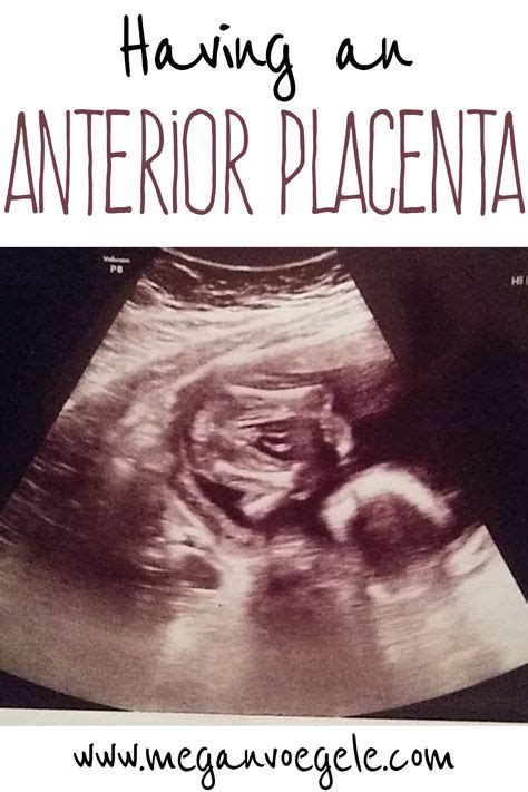 Having An Anterior Placenta Anterior Placenta 24 Weeks Pregnant